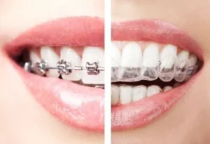 braces invisalign-denthetics