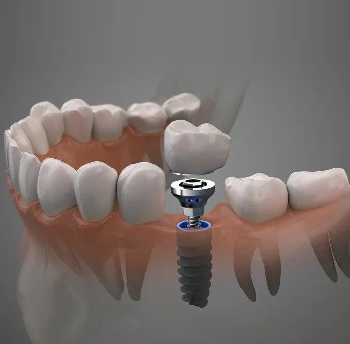 dental implants-denthetics